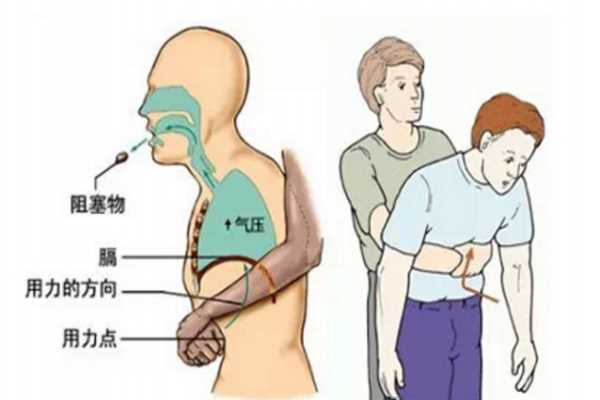 宝宝把口香糖吞下去了怎么办 宝宝噎着急救方法