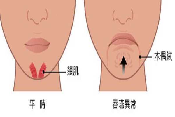 木偶纹怎么消除 让你笑起来更自信