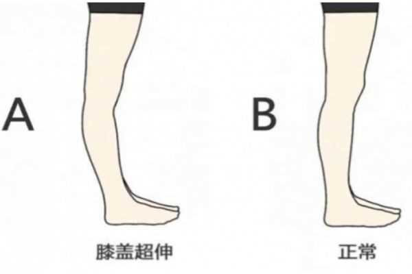 膝关节超伸的危害 会导致以下疾病