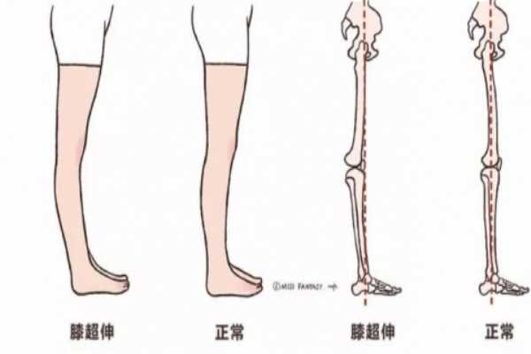 膝关节超伸的危害 会导致以