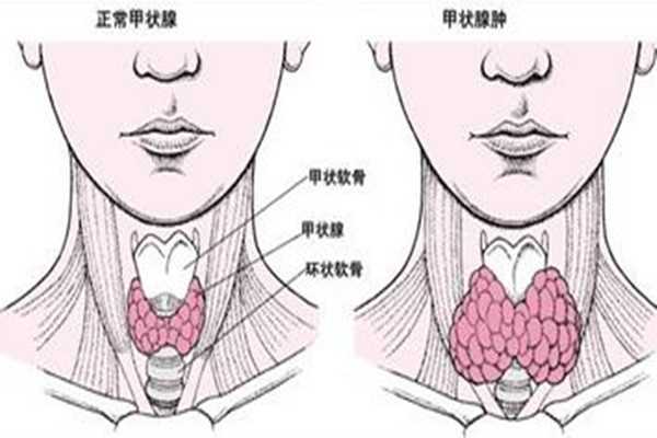 甲状腺结节会导致脖子疼吗 甲状腺结节有什么症状