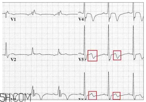 心电图怎么看？6种常见心电图异常情况