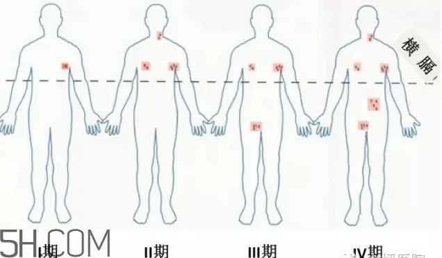 淋巴癌是怎么回事？淋巴癌如何诊断