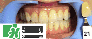 牙齿美白的方法有那些 牙齿美白心得